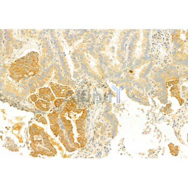 IL6 Antibody - DF6087 at 1/100 staining Human lung cancer by IHC-P.