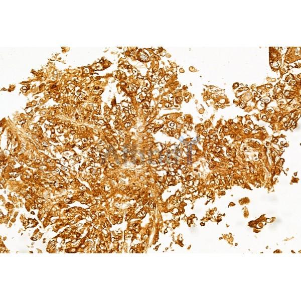 IL1 beta Antibody - DF6251 at 1/100 staining Human liver cancer by IHC-P.