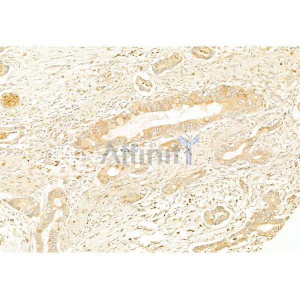 IL1 beta Antibody - DF6251 at 1/100 staining Human pancreatic cancer by IHC-P.