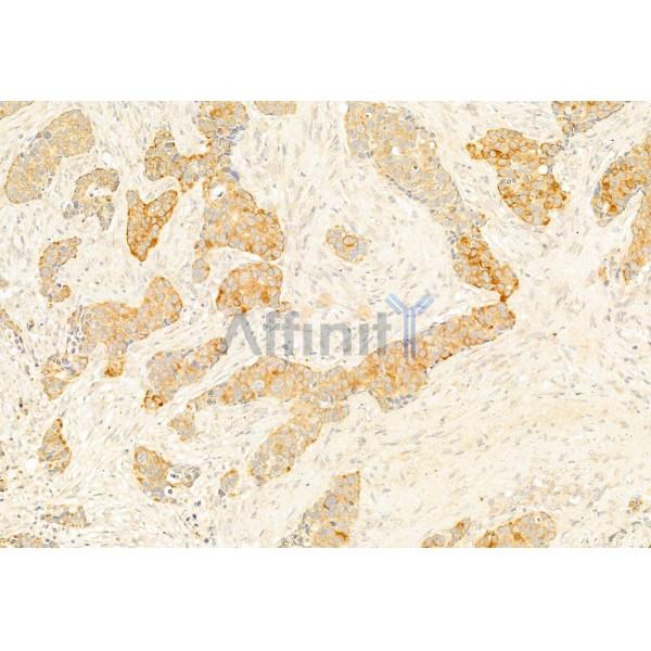 IL1 beta Antibody - DF6251 at 1/100 staining Human mammary cancer by IHC-P.