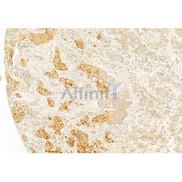 IL1 beta Antibody - DF6251 at 1/100 staining Human mammary cancer by IHC-P.