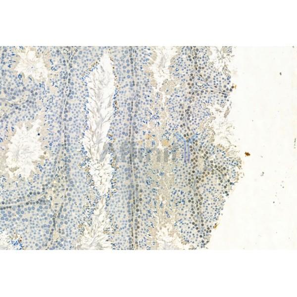 PARP1 Antibody - DF7198 at 1/100 staining Human gastric cancer by IHC-P.