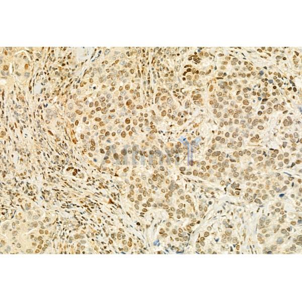 MUC2 Antibody - DF8390 at 1/100 staining Human mammary cancer by IHC-P.