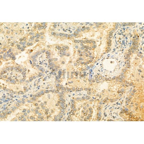 MUC2 Antibody - DF8390 at 1/100 staining Human lung cancer by IHC-P.