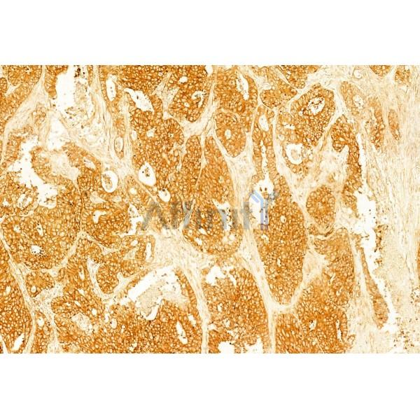 Ameloblastin Antibody - DF8503 at 1/100 staining Human colorectal cancer by IHC-P.