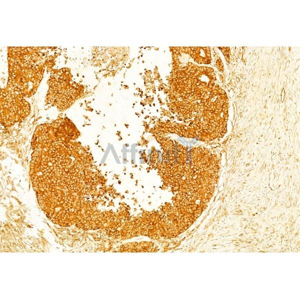 Ameloblastin Antibody - DF8503 at 1/100 staining Human colorectal cancer by IHC-P.