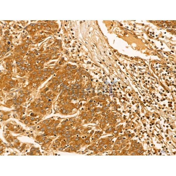 HIF1A Antibody - AF1009 at 1/100 staining Human liver cancer by IHC-P.