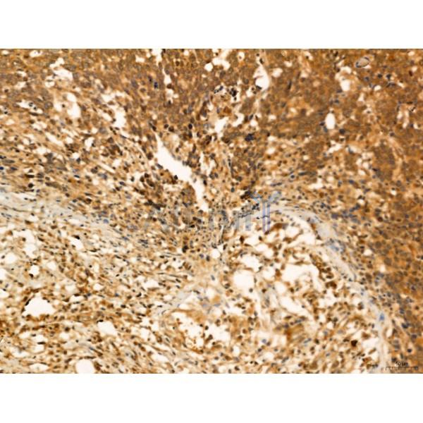HIF1A Antibody - AF1009 at 1/100 staining Human gastric cancer by IHC-P.