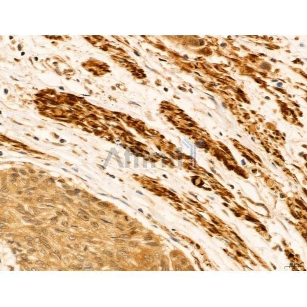 HIF1A Antibody - AF1009 at 1/100 staining Human esophageal cancer by IHC-P.