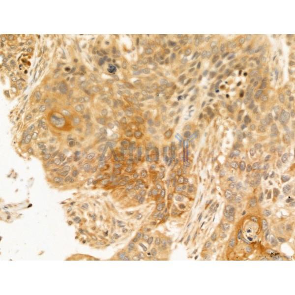 HIF1A Antibody - AF1009 at 1/100 staining Human lung cancer by IHC-P.