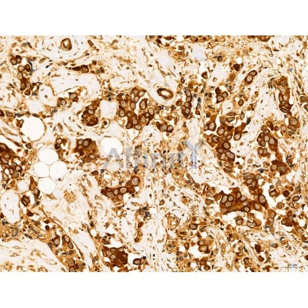 HIF1A Antibody - AF1009 at 1/100 staining Human mammary cancer by IHC-P.