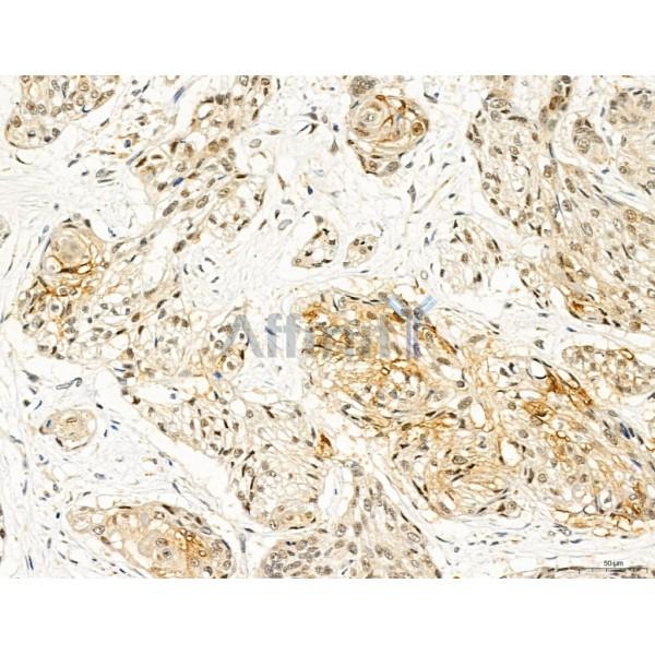 TGFBR1 Antibody - AF5347 at 1/100 staining Human esophageal cancer by IHC-P.