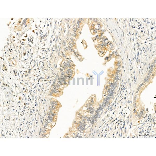 TGFBR1 Antibody - AF5347 at 1/100 staining Human pancreatic cancer by IHC-P.