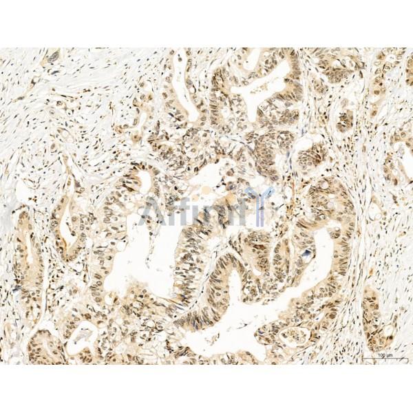 TGFBR1 Antibody - AF5347 at 1/100 staining Human colorectal cancer by IHC-P.