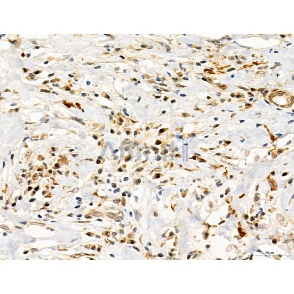 TGFBR1 Antibody - AF5347 at 1/100 staining Human mammary cancer by IHC-P.