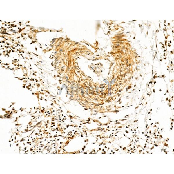TGFBR1 Antibody - AF5347 at 1/100 staining Human colorectal cancer by IHC-P.