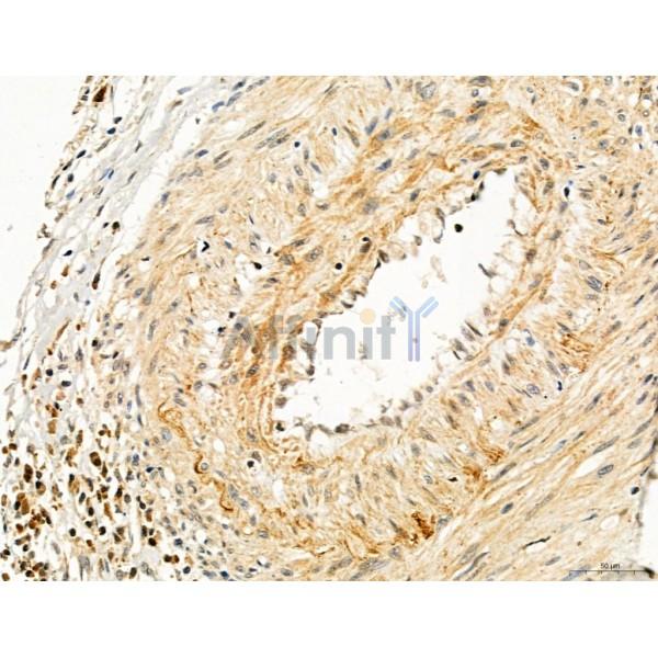 TGFBR1 Antibody - AF5347 at 1/100 staining Human gastric cancer by IHC-P.