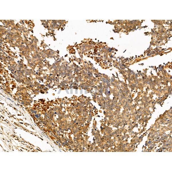NOD2 Antibody - DF12125 at 1/100 staining Human gastric cancer by IHC-P.