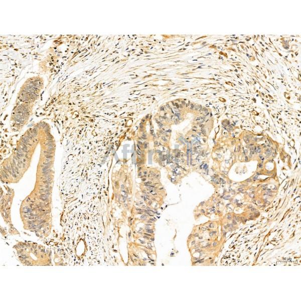NOD2 Antibody - DF12125 at 1/100 staining Human colorectal cancer by IHC-P.