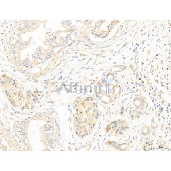 NOD2 Antibody - DF12125 at 1/100 staining Human pancreatic cancer by IHC-P.