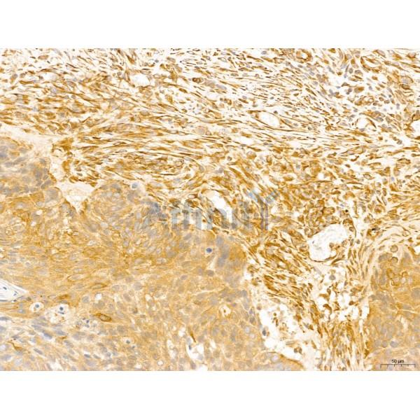 NOD2 Antibody - DF12125 at 1/100 staining Human lung cancer by IHC-P.