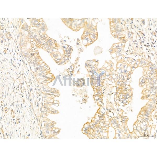 NOD2 Antibody - DF12125 at 1/100 staining Human pancreatic cancer by IHC-P.