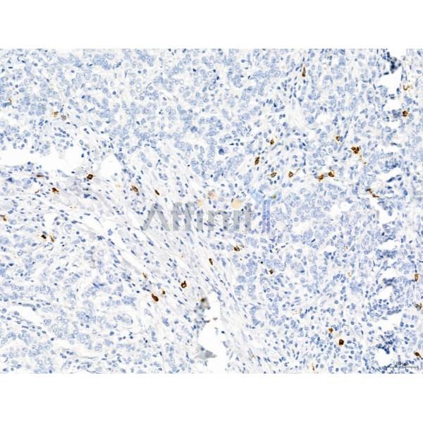 PDLIM7 Antibody - DF12130 at 1/100 staining Human mammary cancer by IHC-P.