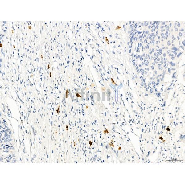 PDLIM7 Antibody - DF12130 at 1/100 staining Human esophageal cancer by IHC-P.