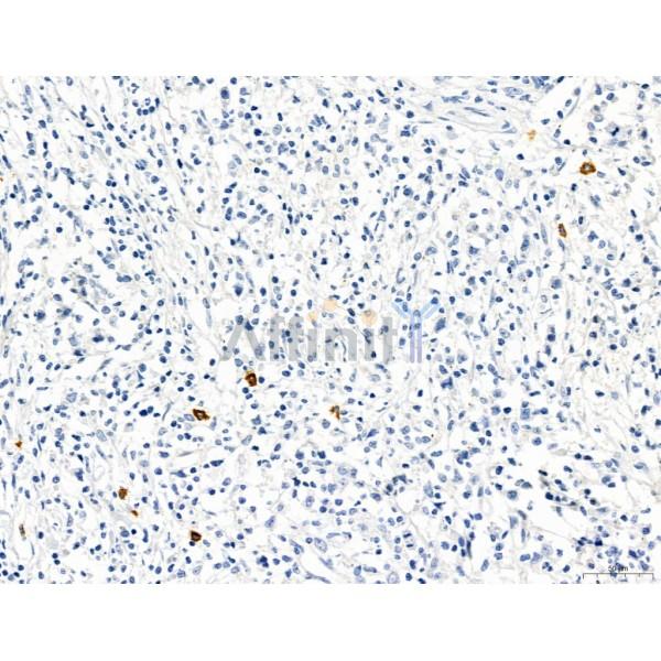 PDLIM7 Antibody - DF12130 at 1/100 staining Human colorectal cancer by IHC-P.