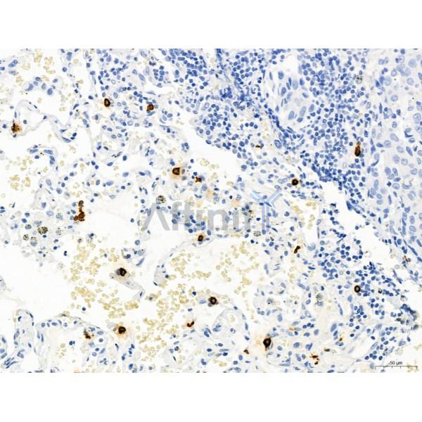 PDLIM7 Antibody - DF12130 at 1/100 staining Human lung cancer by IHC-P.