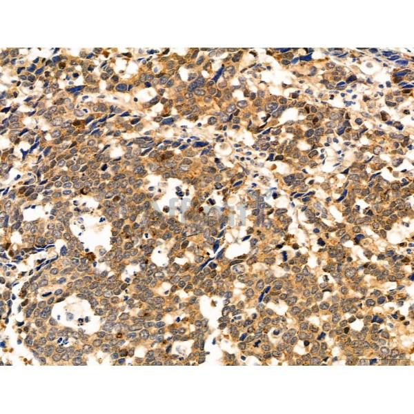 DDIT3/CHOP Antibody - DF6025 at 1/100 staining Human gastric cancer by IHC-P.