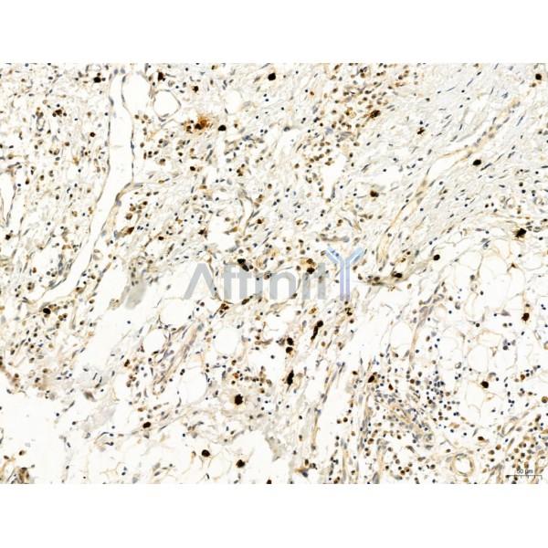 DDIT3/CHOP Antibody - DF6025 at 1/100 staining Human colorectal cancer by IHC-P.