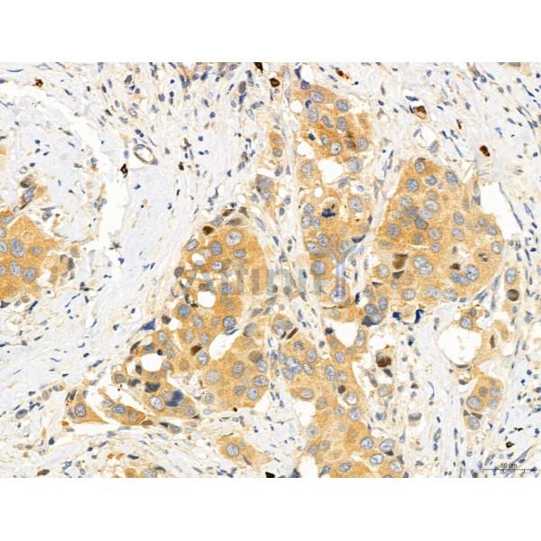 DDIT3/CHOP Antibody - DF6025 at 1/100 staining Human mammary cancer by IHC-P.