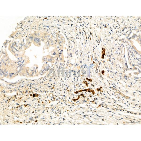 DDIT3/CHOP Antibody - DF6025 at 1/100 staining Human pancreatic cancer by IHC-P.