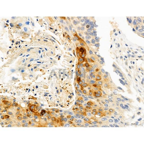 DDIT3/CHOP Antibody - DF6025 at 1/100 staining Human lung cancer by IHC-P.