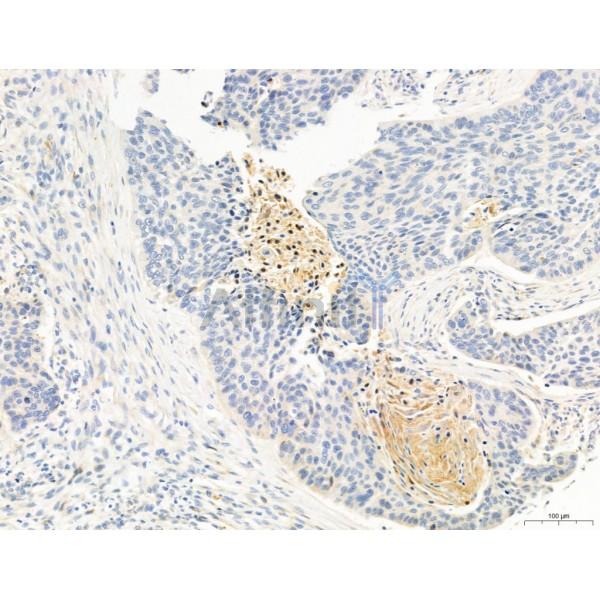 RANKL Antibody - DF7006 at 1/100 staining Human lung cancer by IHC-P.