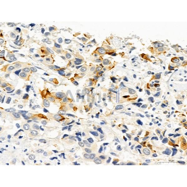 RANKL Antibody - DF7006 at 1/100 staining Human mammary cancer by IHC-P.