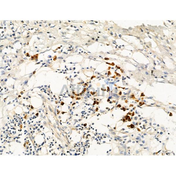 KISS1R Antibody - DF7123 at 1/100 staining Human gastric cancer by IHC-P.