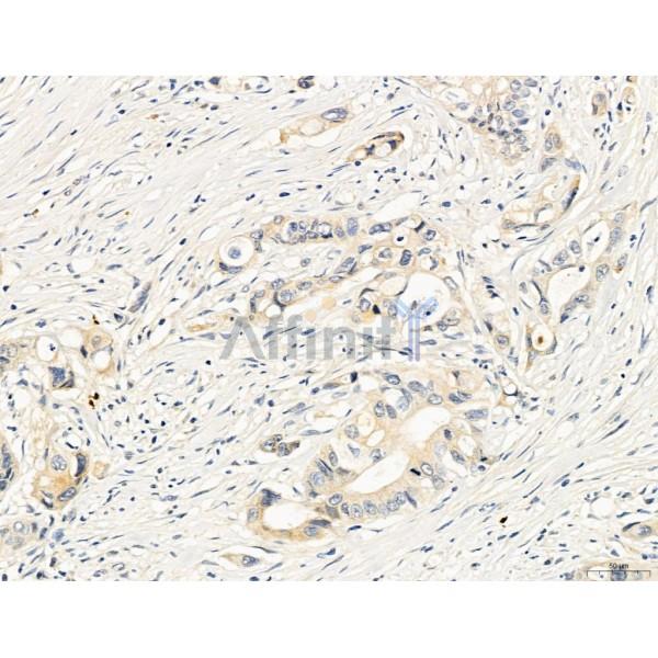 KISS1R Antibody - DF7123 at 1/100 staining Human colorectal cancer by IHC-P.