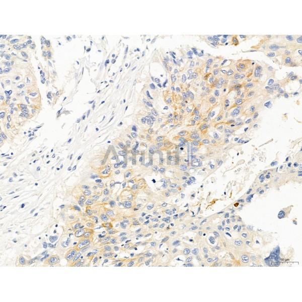 KISS1R Antibody - DF7123 at 1/100 staining Human lung cancer by IHC-P.