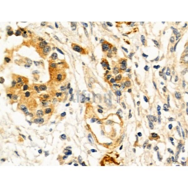 KISS1R Antibody - DF7123 at 1/100 staining Human pancreatic cancer by IHC-P.