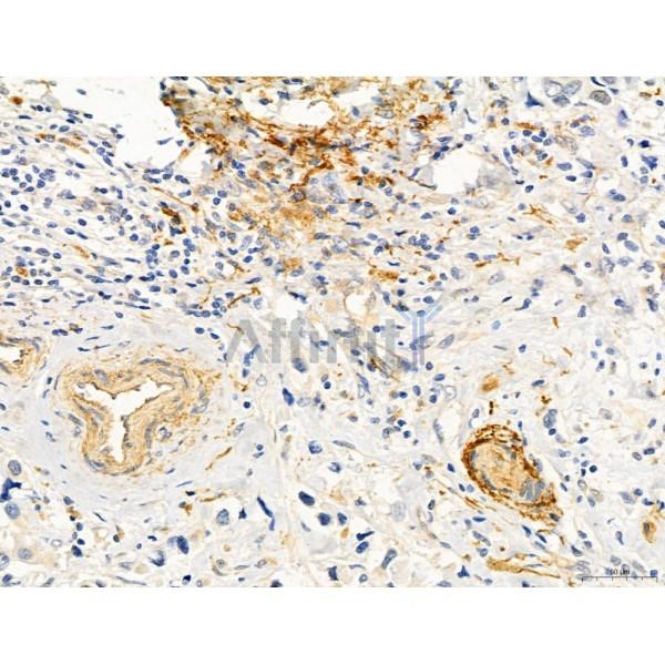 KISS1R Antibody - DF7123 at 1/100 staining Human mammary cancer by IHC-P.