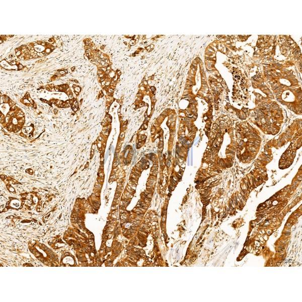 SLC22A8 Antibody - DF7196 at 1/100 staining Human colorectal cancer by IHC-P.