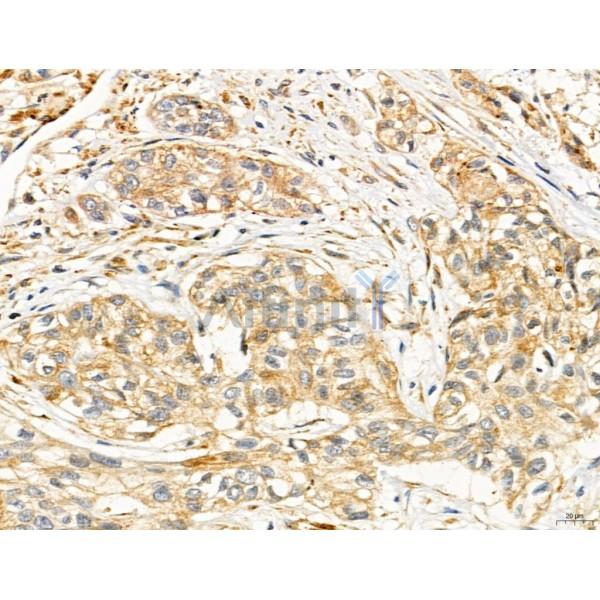 SLC22A8 Antibody - DF7196 at 1/100 staining Human esophageal cancer by IHC-P.