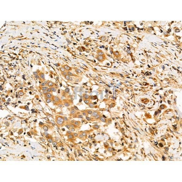SLC22A8 Antibody - DF7196 at 1/100 staining Human mammary cancer by IHC-P.