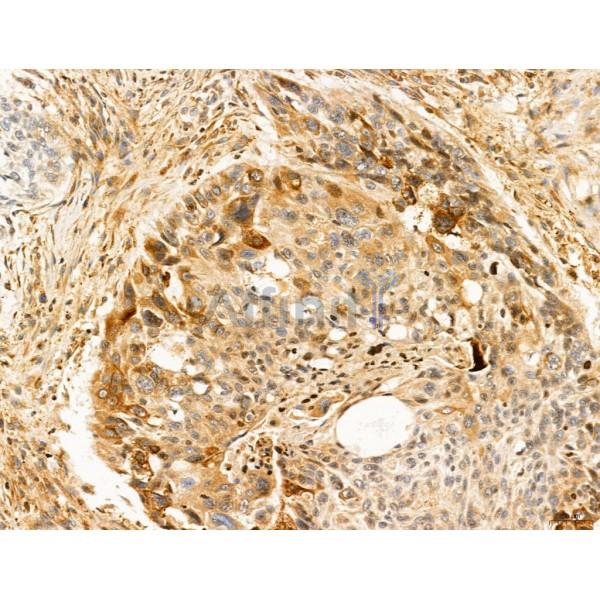 SLC22A8 Antibody - DF7196 at 1/100 staining Human lung cancer by IHC-P.