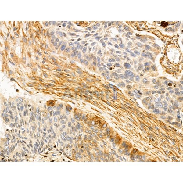 SLC22A8 Antibody - DF7196 at 1/100 staining Human lung cancer by IHC-P.