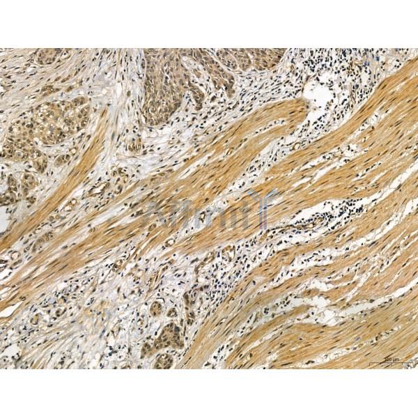 MUC16 Antibody - DF7989 at 1/100 staining Human esophageal cancer by IHC-P.