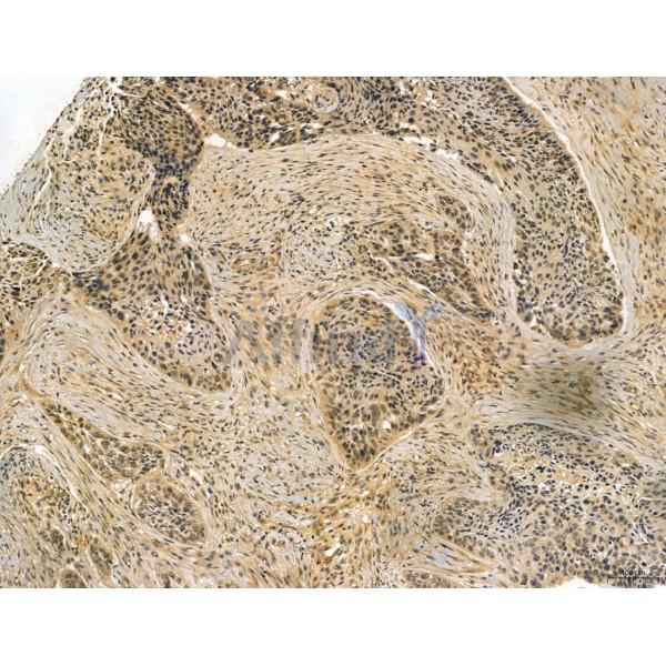 MUC16 Antibody - DF7989 at 1/100 staining Human lung cancer by IHC-P.