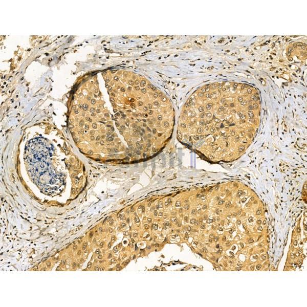 MUC16 Antibody - DF7989 at 1/100 staining Human mammary cancer by IHC-P.